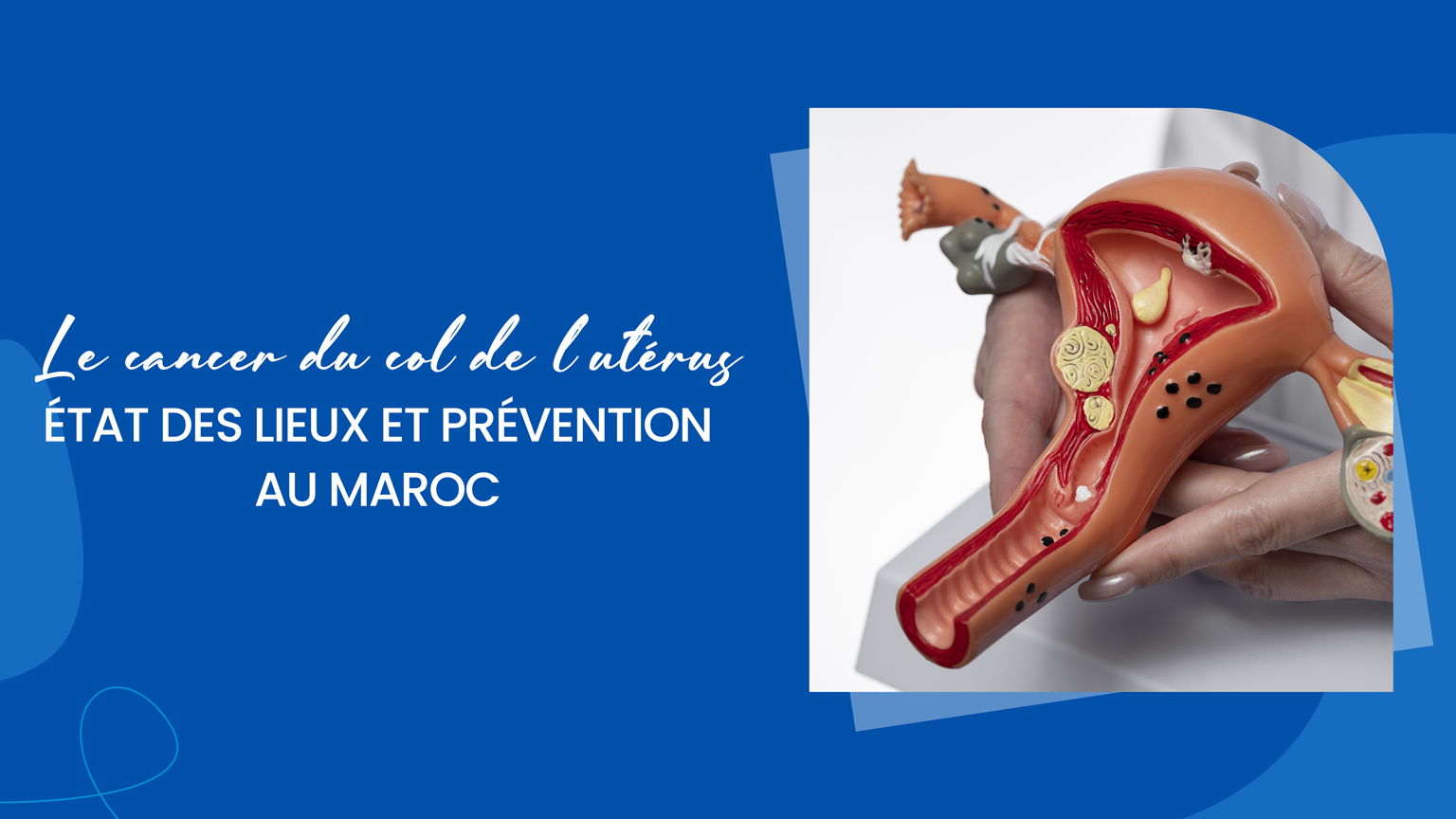 D.lahbabi Kamal Le cancer du col de l’utérus, état des lieux et prévention au Maroc.